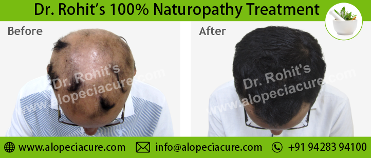 hair loss treatment